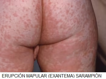 exantema-sarampion