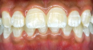 fluorosis