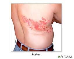 herpes-zoster